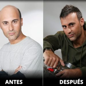 Prótesis Parcial Hombre