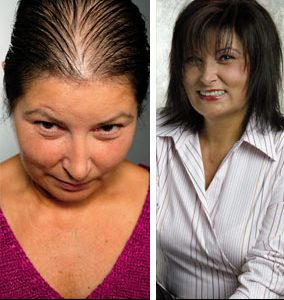 Prótesis Parcial Mujer