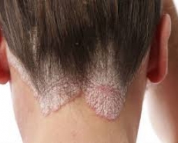 peinados para mujeres alopecia frontal